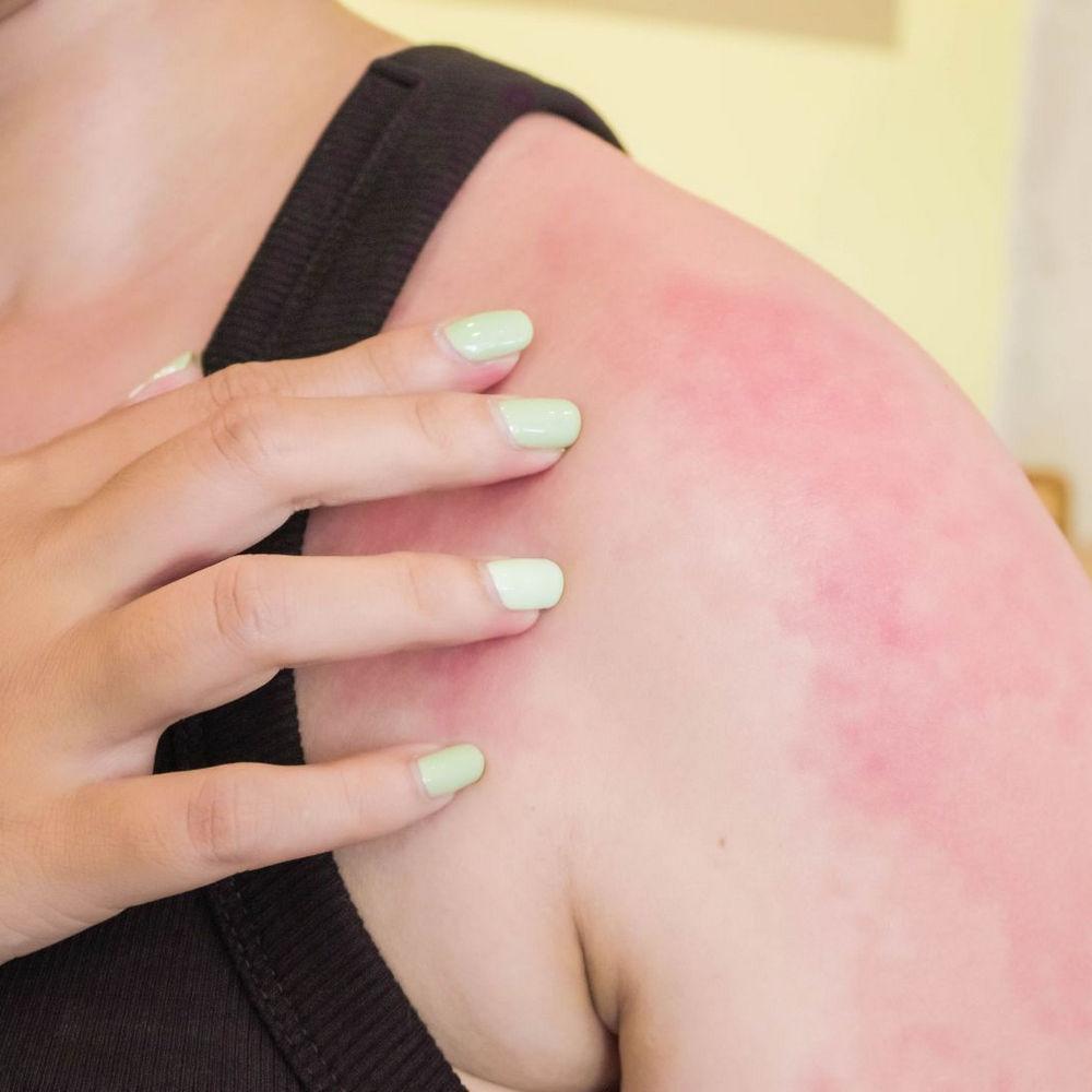 Бывает ли аллергия на солнце?